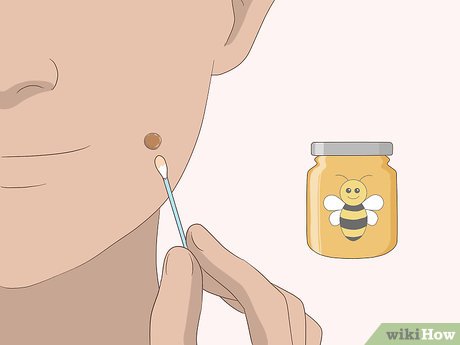 以Remove Moles Quickly Step 15为标题的图片