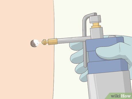 以Remove Moles Quickly Step 5为标题的图片