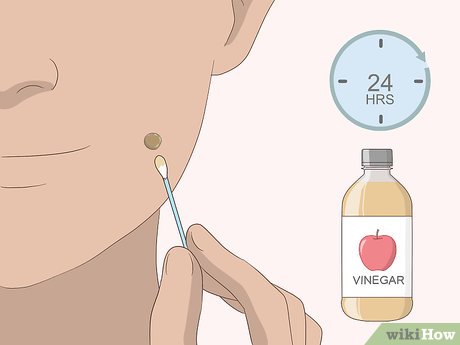 以Remove Moles Quickly Step 9为标题的图片