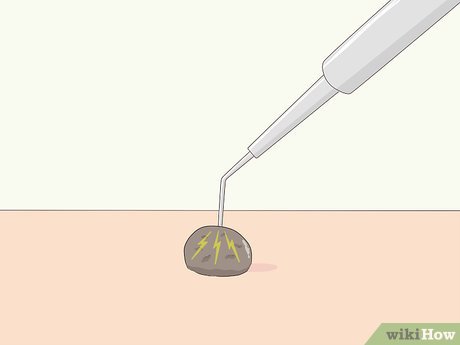 以Remove Moles Quickly Step 7为标题的图片