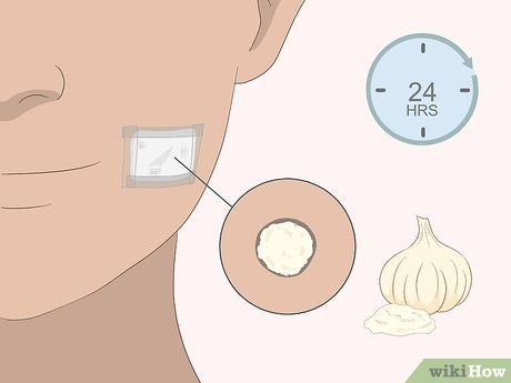 以Remove Moles Quickly Step 10为标题的图片