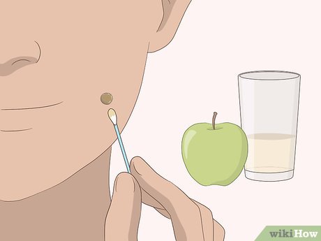 以Remove Moles Quickly Step 12为标题的图片