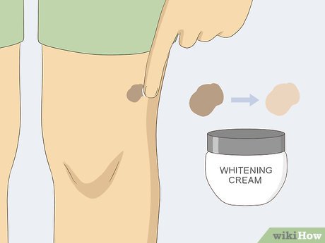 以Remove Moles Quickly Step 18为标题的图片