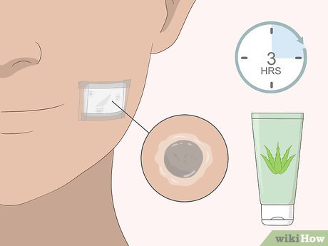 以Remove Moles Quickly Step 8为标题的图片