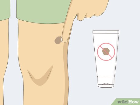 以Remove Moles Quickly Step 17为标题的图片