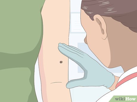 以Remove Moles Quickly Step 1为标题的图片