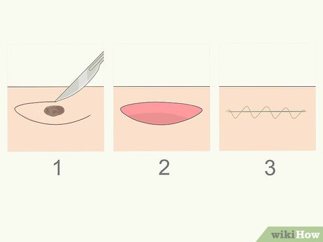 以Remove Moles Quickly Step 4为标题的图片